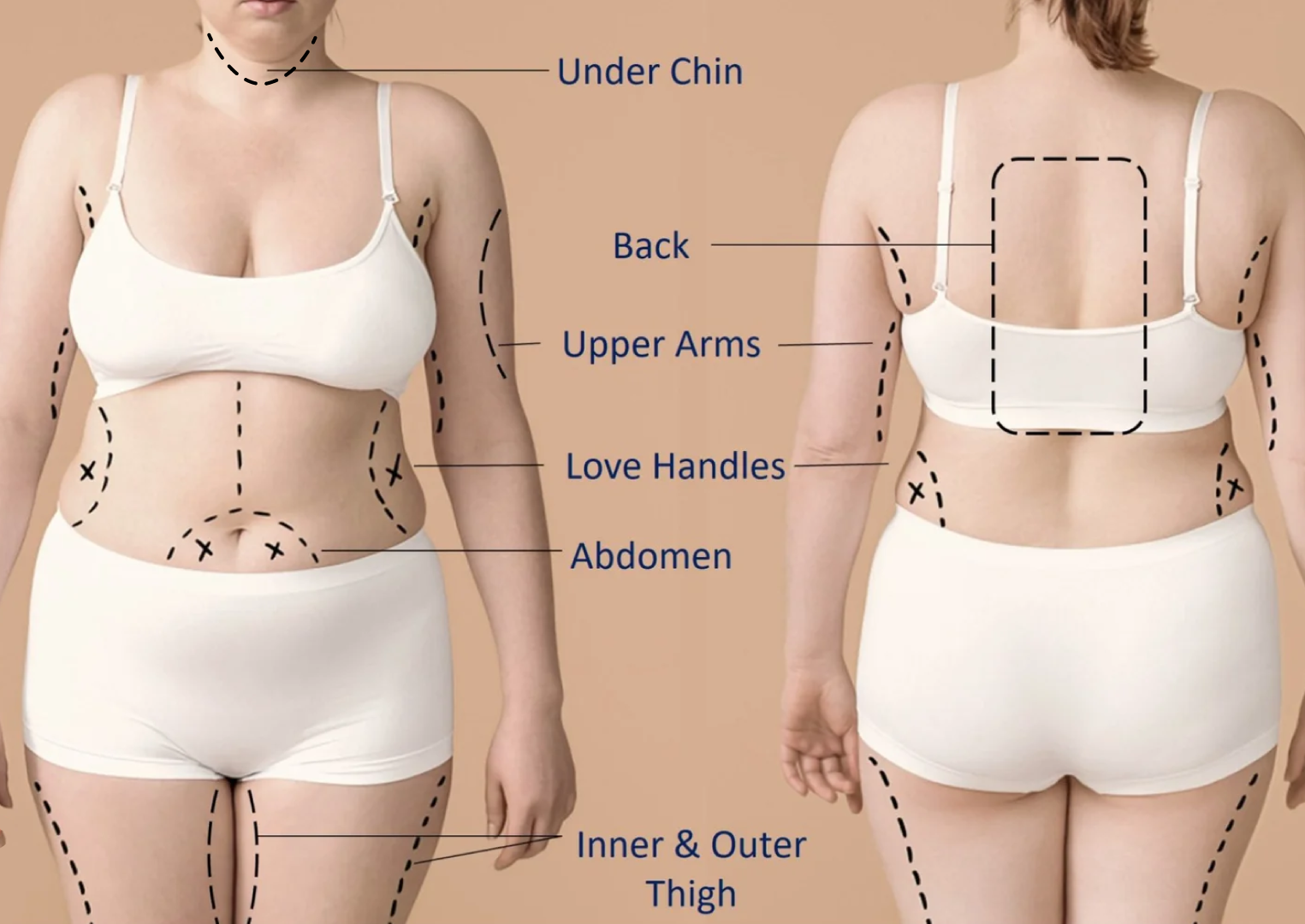 Areas-Lipo