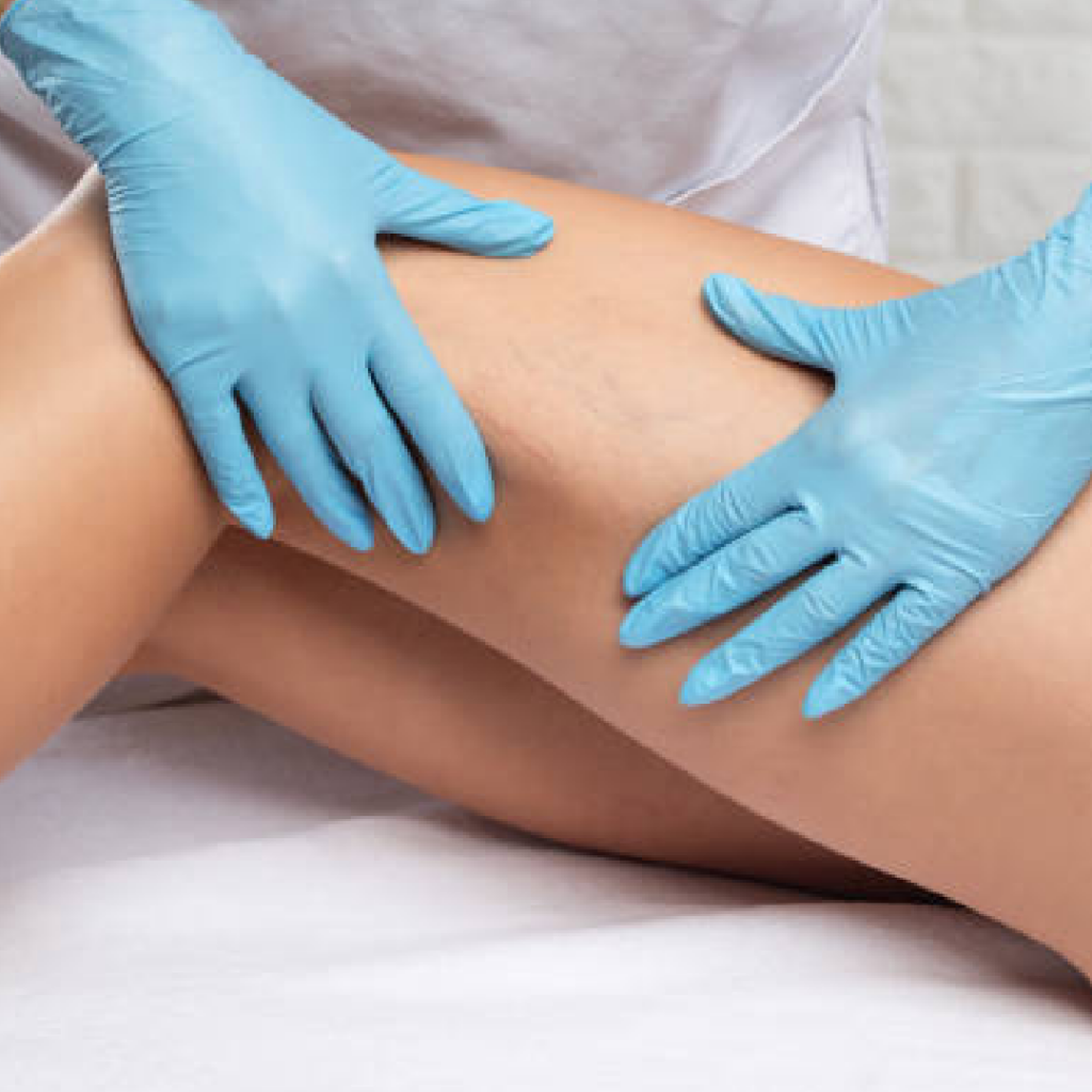 Gloved hands supporting a leg, representing sclerotherapy planning for spider vein appearance.