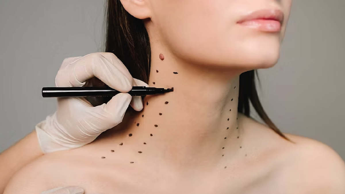 Nefertiti technique for neck rejuvenation and jawline definition concept