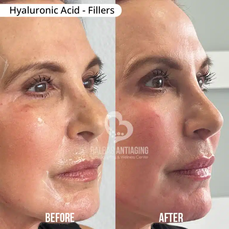 Hyaluronic_Acid_Fillers_BalbasAntiaging4