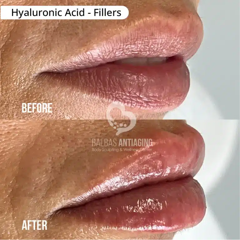 Hyaluronic_Acid_Fillers_BalbasAntiaging7