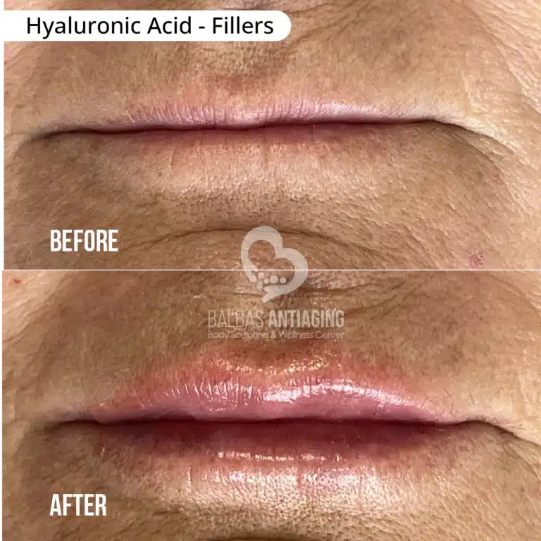 Hyaluronic_Acid_Fillers_BalbasAntiaging8