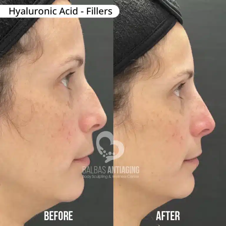 Hyaluronic_Acid_Fillers_BalbasAntiaging9