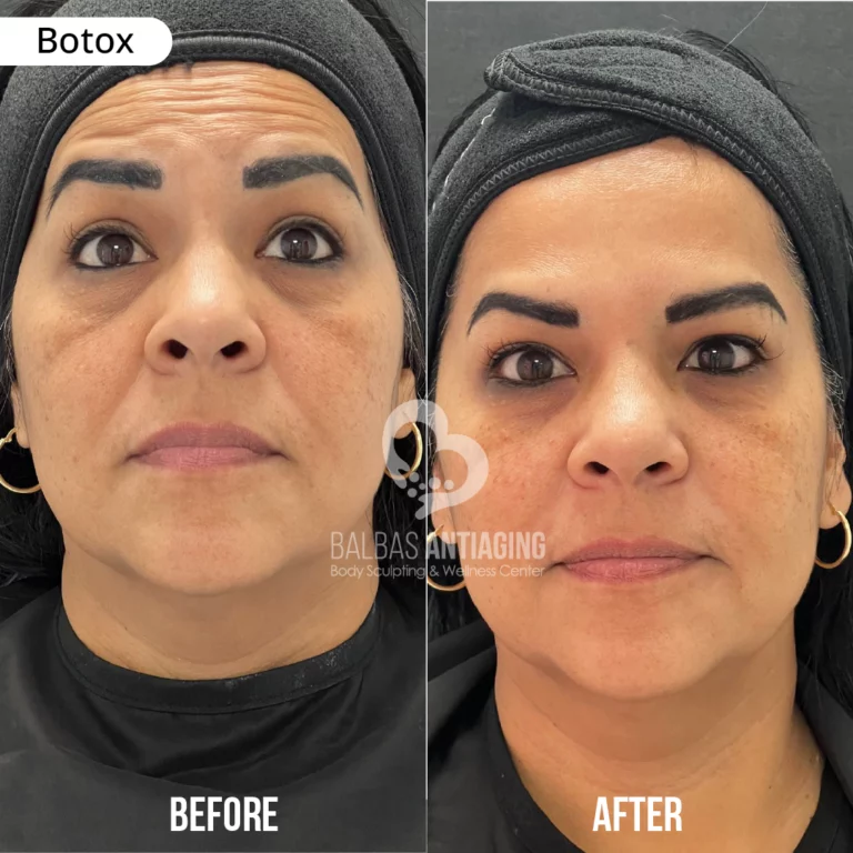 before_and_after_botox_balbas_antiaging2