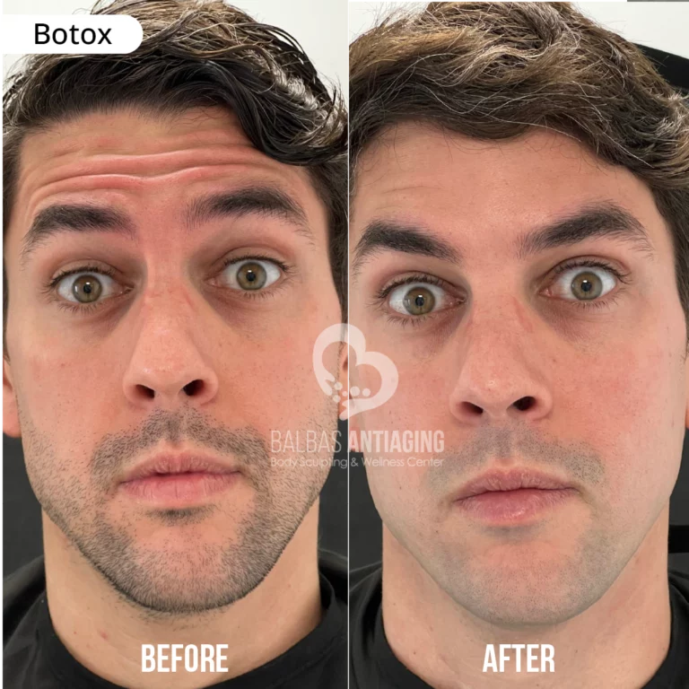 before_and_after_botox_balbas_antiaging4