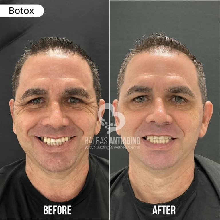 before_and_after_botox_balbas_antiaging6