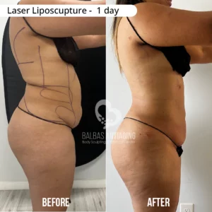 Before and after laser liposculpture results showing body contour refinement.