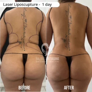 Before and after laser liposculpture showing visible measurement reduction and body contour refinement.