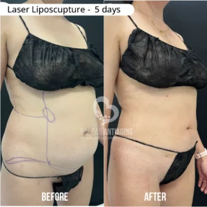 Before and after laser liposculpture results showing visible body contour improvement.