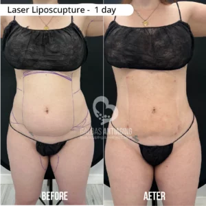 Before and after laser liposculpture showing visible improvement after a custom body contour plan.