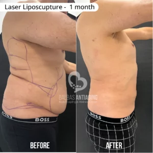 Before and after personalized laser liposculpture body sculpting results.