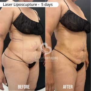 Before and after laser liposculpture showing realistic body sculpting results.