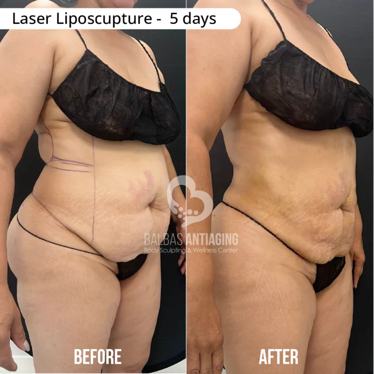 Before and after laser liposculpture showing realistic body sculpting results.