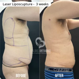 Before and after laser liposculpture showing progressive body contour improvement.