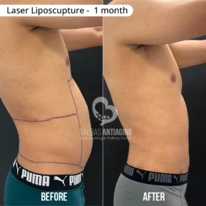 Before and after laser liposculpture showing localized fat reduction and improved contour.