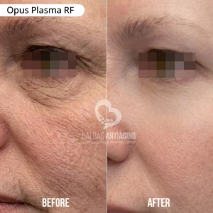 Opus_Plasma_RF_BalbasAntiaging1