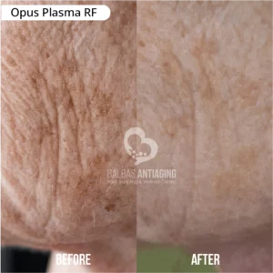 Opus_Plasma_RF_BalbasAntiaging2