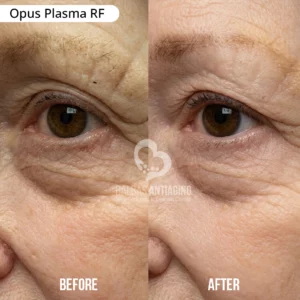 Opus_Plasma_RF_BalbasAntiaging3