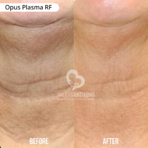 Opus_Plasma_RF_BalbasAntiaging4